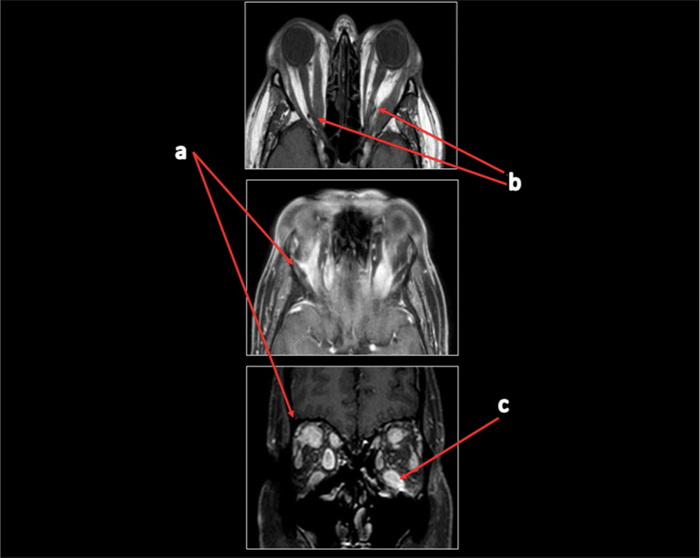 Analyzing histopathological aspects and cell populations in orbital inflammatory involvement in systemic diseases: A case series from the Rheumatologist’s perspective