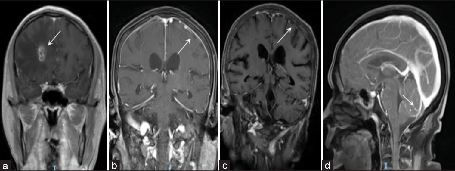 Enhancing the cytological features and diagnostic significance of cerebrospinal fluid in bacterial meningitis