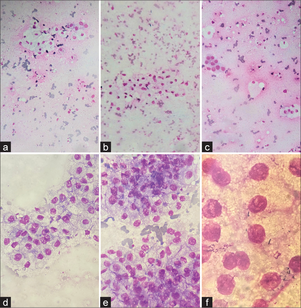 Challenge in the cytological interpretation of a not-so-typical breast carcinoma