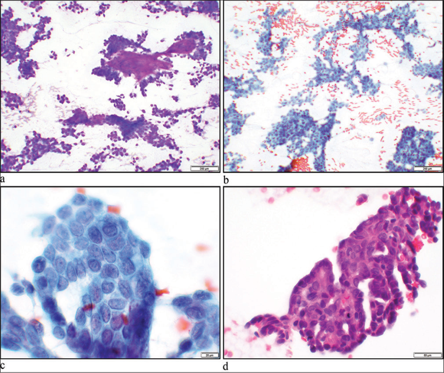 An unusual neck mass diagnosed by fine needle aspiration: Cytological findings and challenges