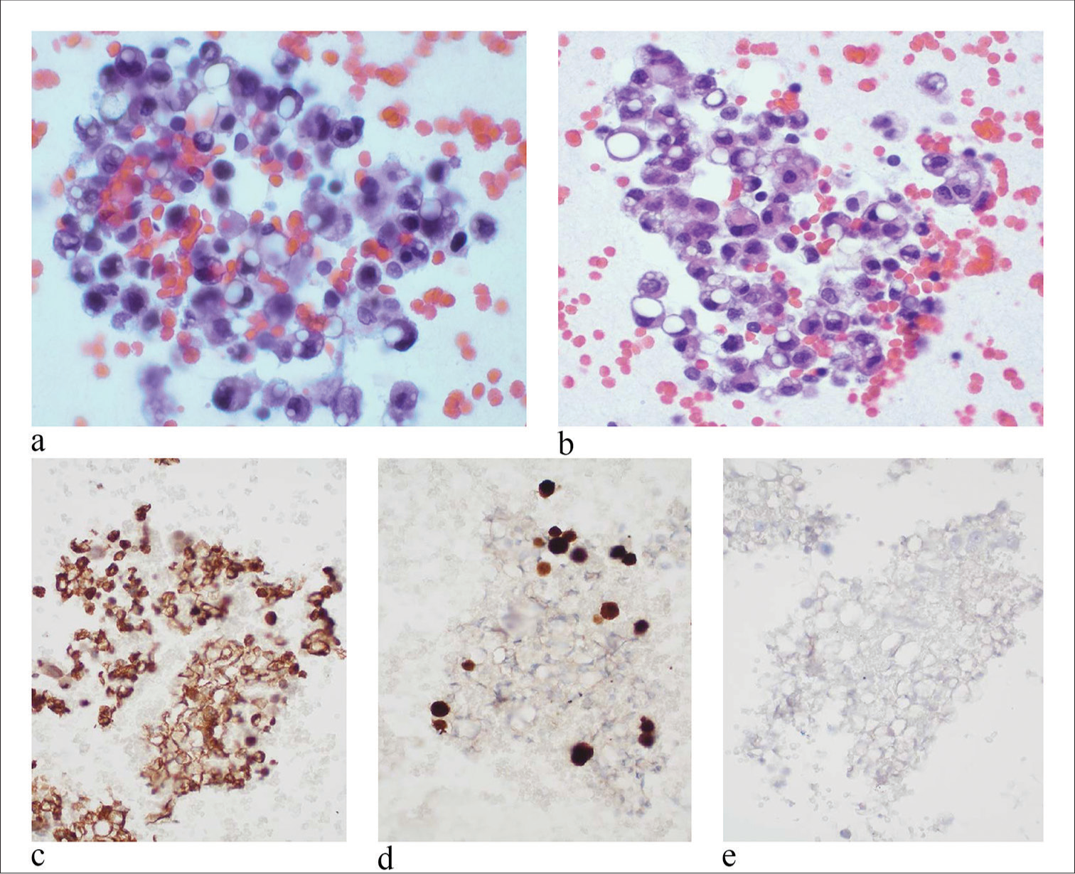 Cytologic diagnosis and differential diagnosis of histiocytic signet ring cells in effusion specimens