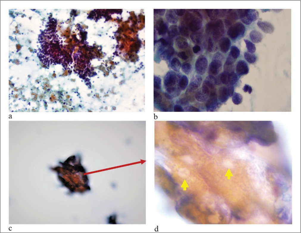 Fine-needle aspiration of basaloid scalp lesion: Potential diagnostic pitfall