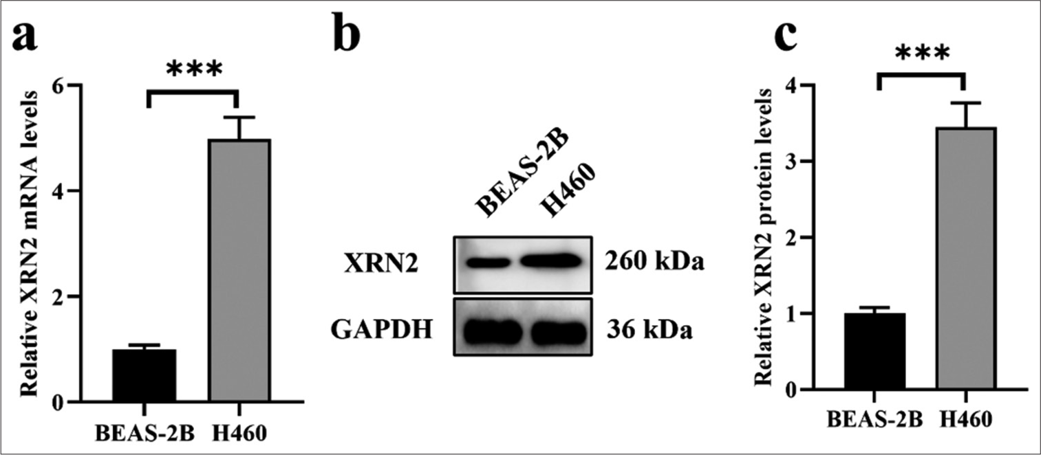 Oncogene 5’-3’ exoribonuclease 2 enhances epidermal growth factor receptor signaling pathway to promote epithelial–mesenchymal transition and metastasis in non-small-cell lung cancer