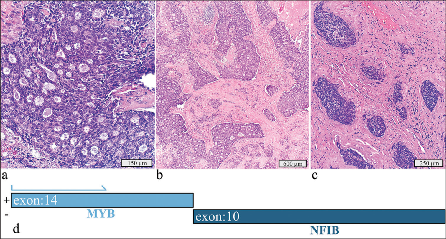 Precision medicine for patients with salivary gland neoplasms: Determining the feasibility of implementing a next-generation sequencing-based RNA assay in a hospital laboratory