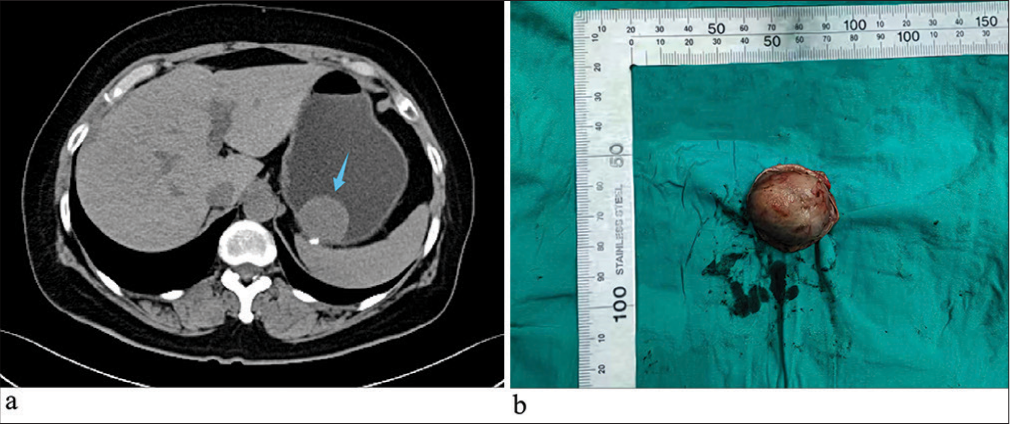 Gastrointestinal stromal tumor mimicking perineurioma: A case report