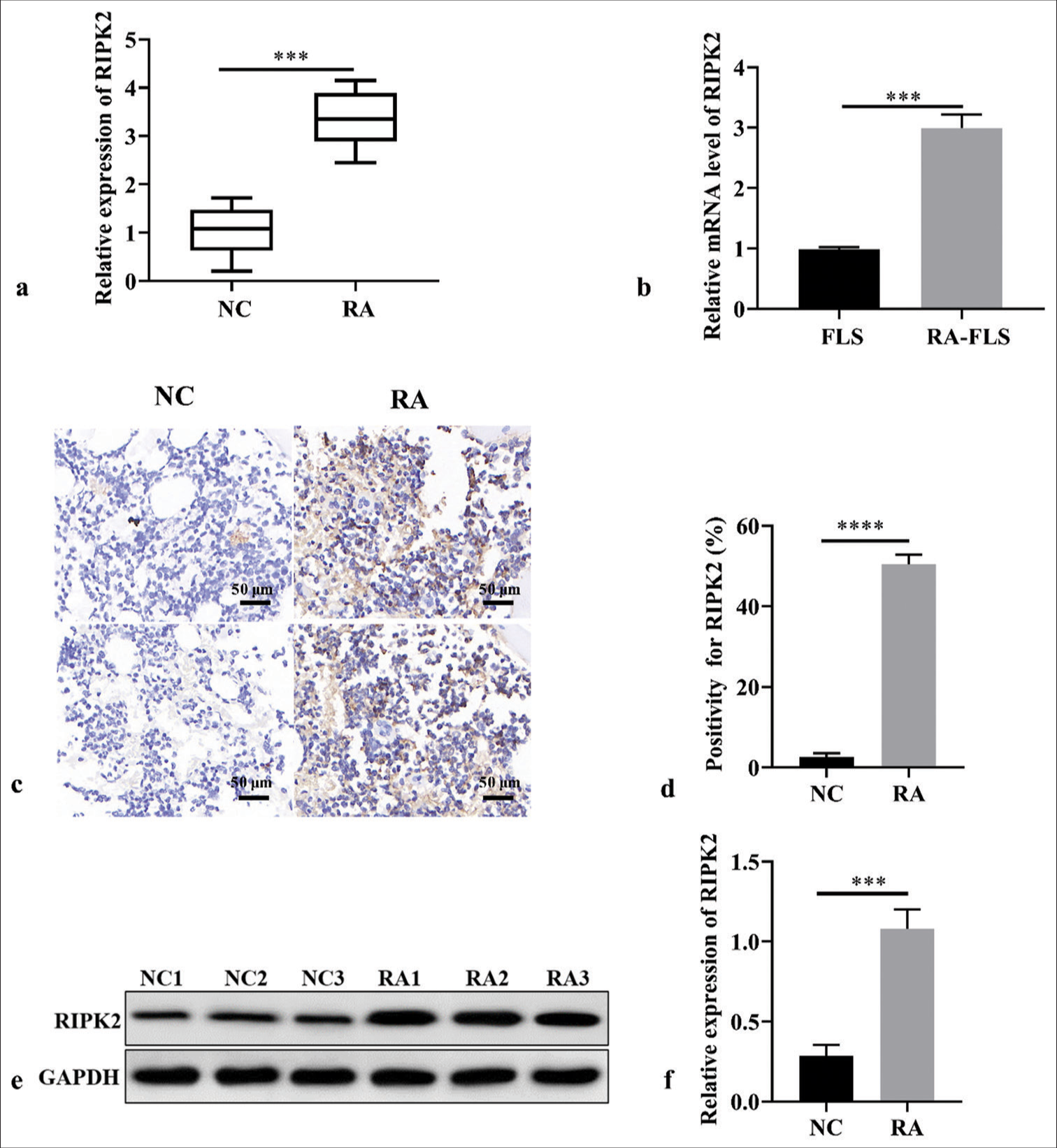 Receptor interacting serine/threonine kinase 2 promotes rheumatoid arthritis progression and partially regulates nuclear factor kappa B pathway