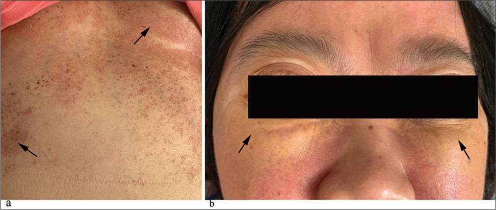 Overlap syndrome of Erdheim-Chester disease and Langerhans cell histiocytosis: A case report