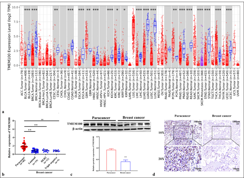 Detection of transmembrane protein 100 in breast cancer: Correlation with malignant progression and chemosensitivity