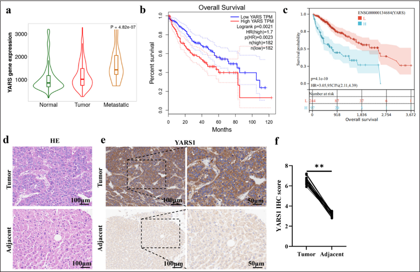 Deciphering the synergistic role of tyrosyl-tRNA synthetase 1 and yes-associated protein 1: Catalysts of malignant progression in hepatocellular carcinoma