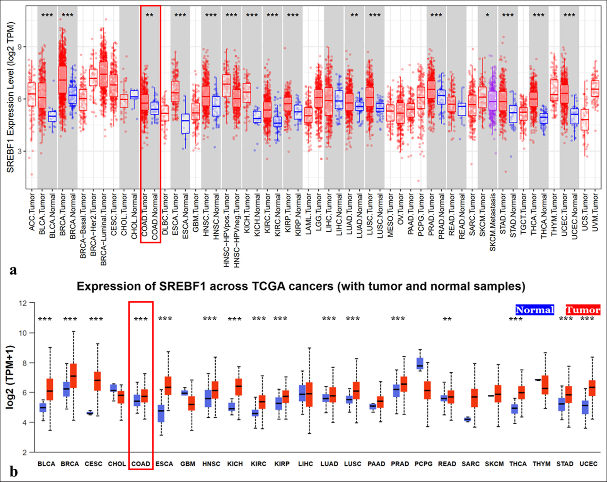 Sterol regulatory element binding transcription factor 1 is an important prognostic factor for colon adenocarcinoma and closely related to immune infiltration