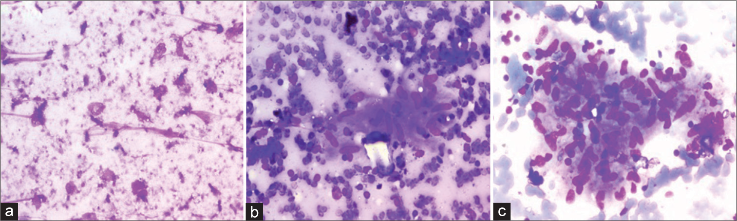 Comparison of liquid based cytology and conventional smears on lymph node aspirates: A cytomorphological study
