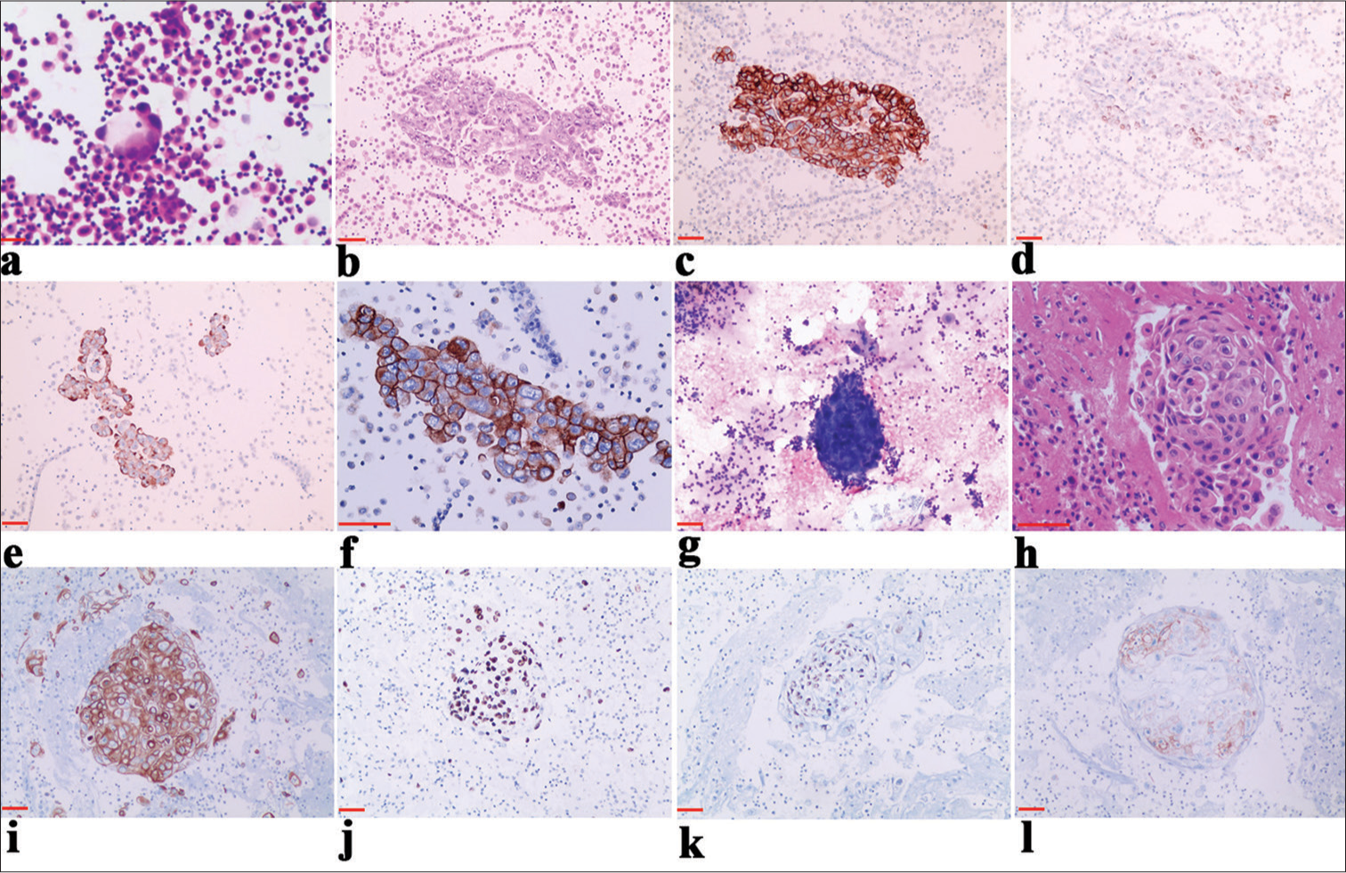 Expression and clinical significance of programmed death ligand-1 evaluated by 22C3 antibody in pleural effusion metastatic non-small-cell lung cancer