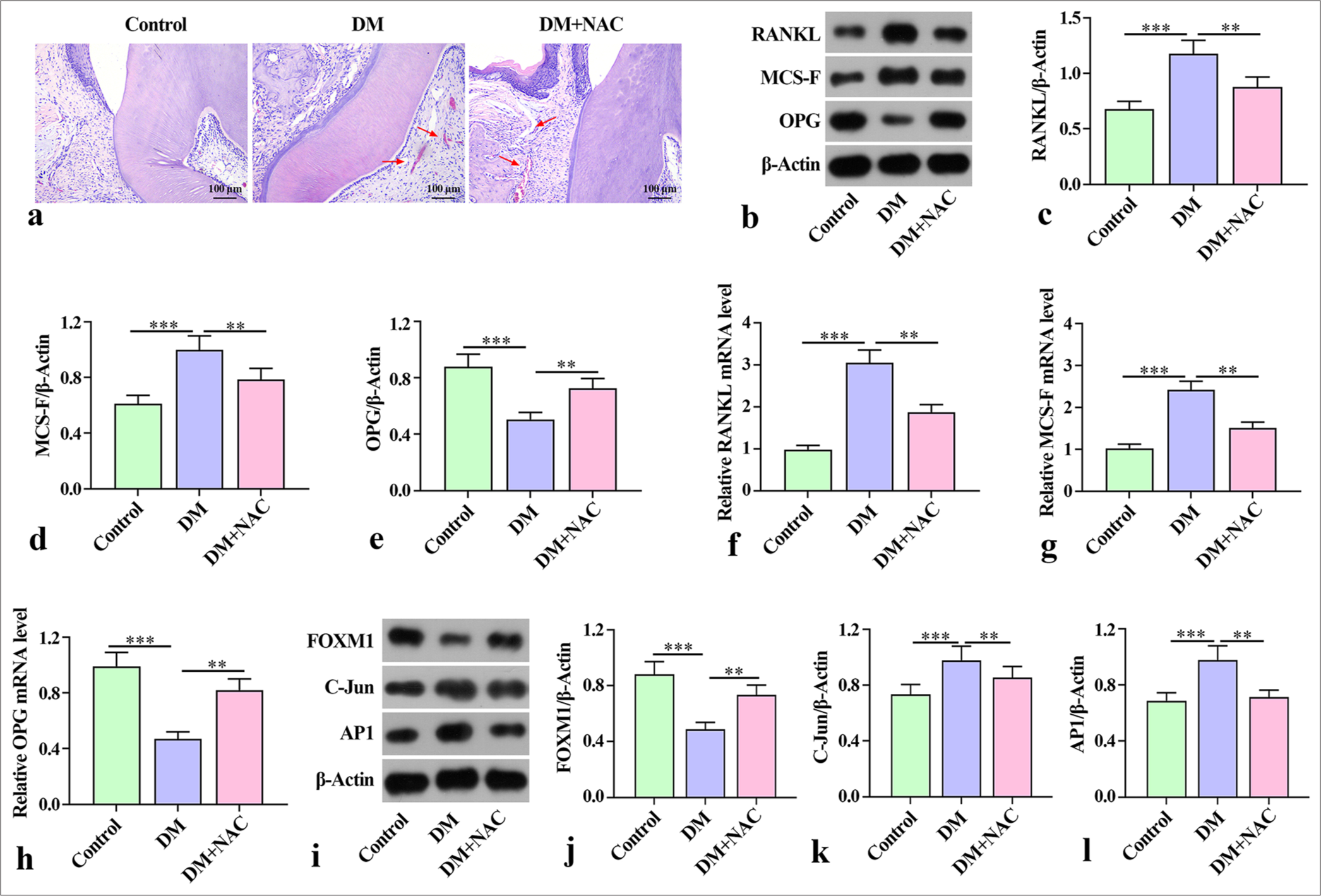 Promotion of inflammatory response in mice with diabetes periodontitis: regulation of forkhead box protein M1 silencing to mediate activator protein-1 via reactive oxygen species production