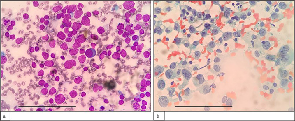 Utility of fine-needle aspiration cytology combined with flow cytometry in extramedullary hematolymphoid lesions – A cross-sectional study