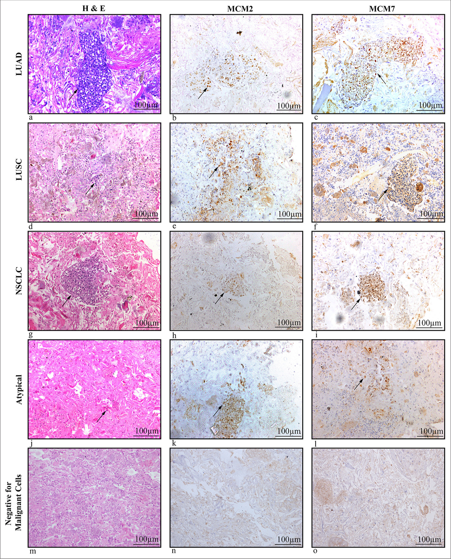 Expression of minichromosome maintenance proteins in the exfoliated cells supplement sputum cytology in the diagnosis of lung cancer