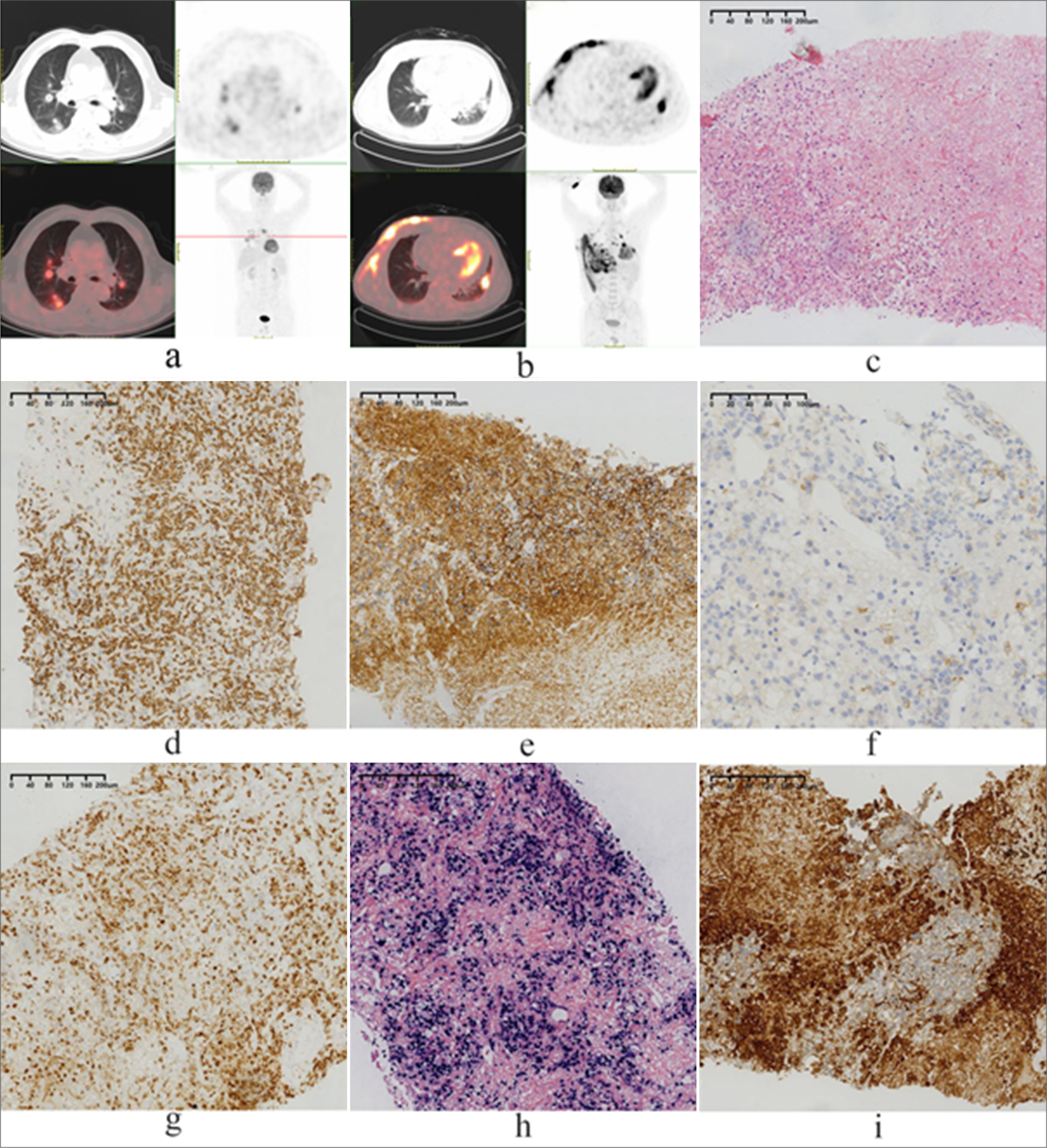 Pulmonary extranodal NK/T-cell lymphoma: A clinicopathological analysis of five patients