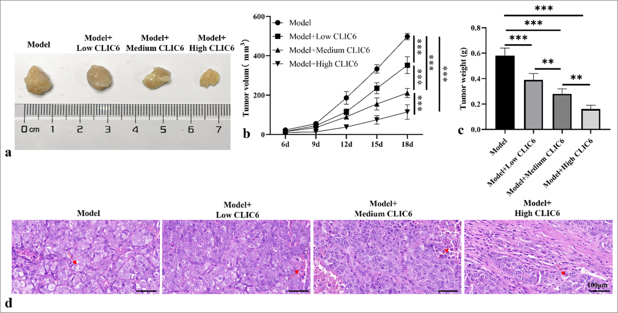 Chloride intracellular channel 6 inhibits hepatocellular carcinoma progression by modulating immune cell balance and promoting tumor cell apoptosis