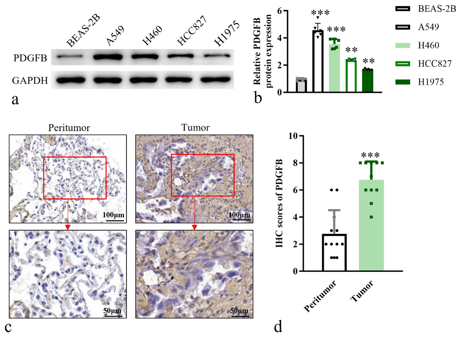 Platelet-derived growth factor subunit B overexpression promotes lung cancer tumor growth and metastasis: The role of glucose metabolism