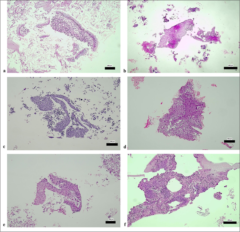Diagnostic utility of cell block preparations from liquid-based cytology in cervical lesions: A comparative retrospective analysis