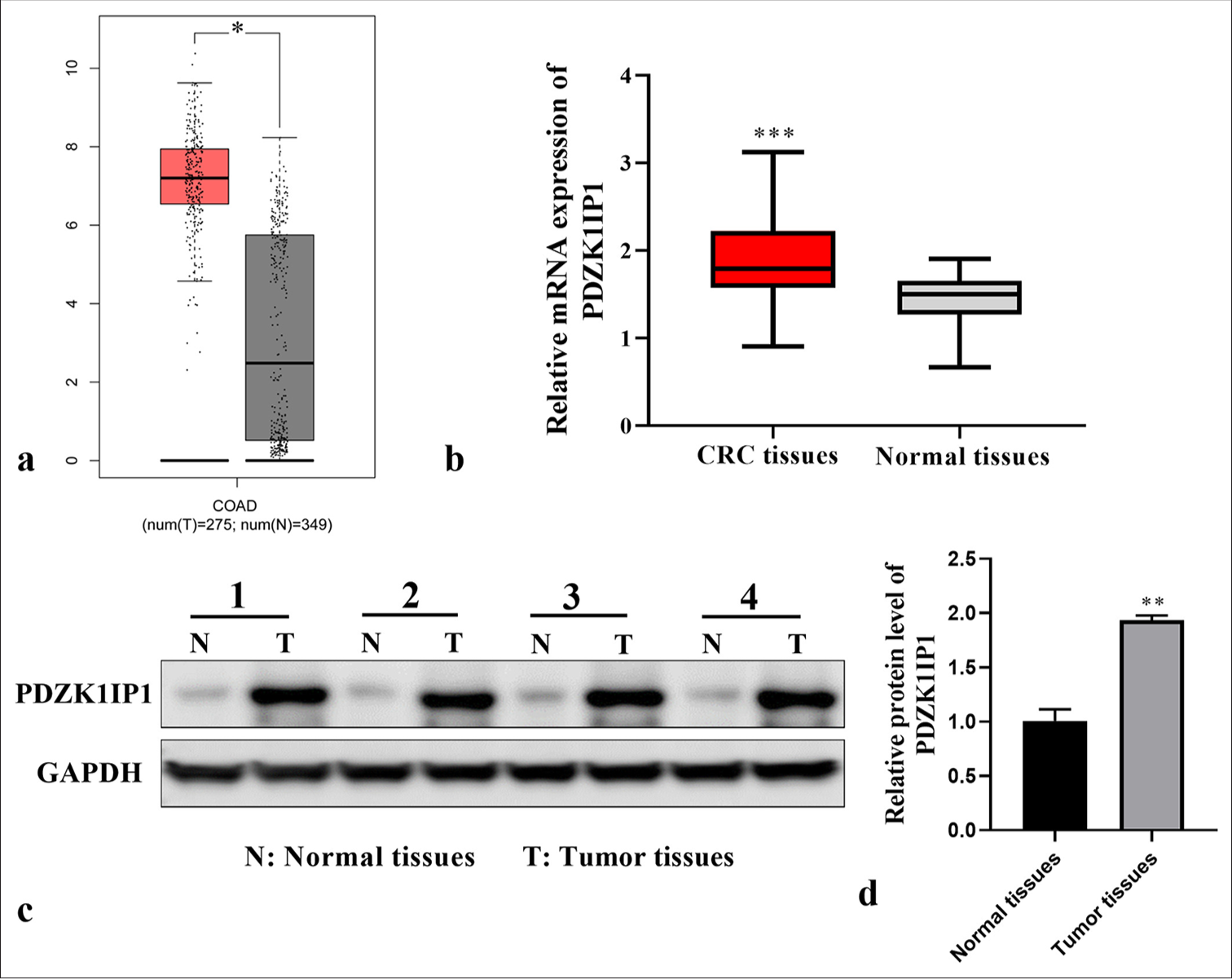 Mechanistic insights into PDZK1-interacting protein 1 on the malignant progression of colorectal carcinoma
