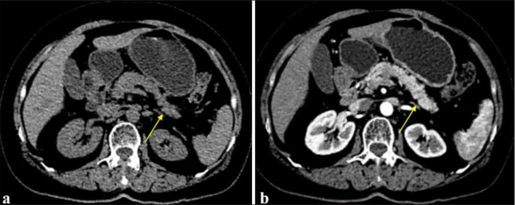 Endoscopic ultrasound-guided fine-needle aspiration value in suspected autoimmune pancreatitis malignancy diagnosis