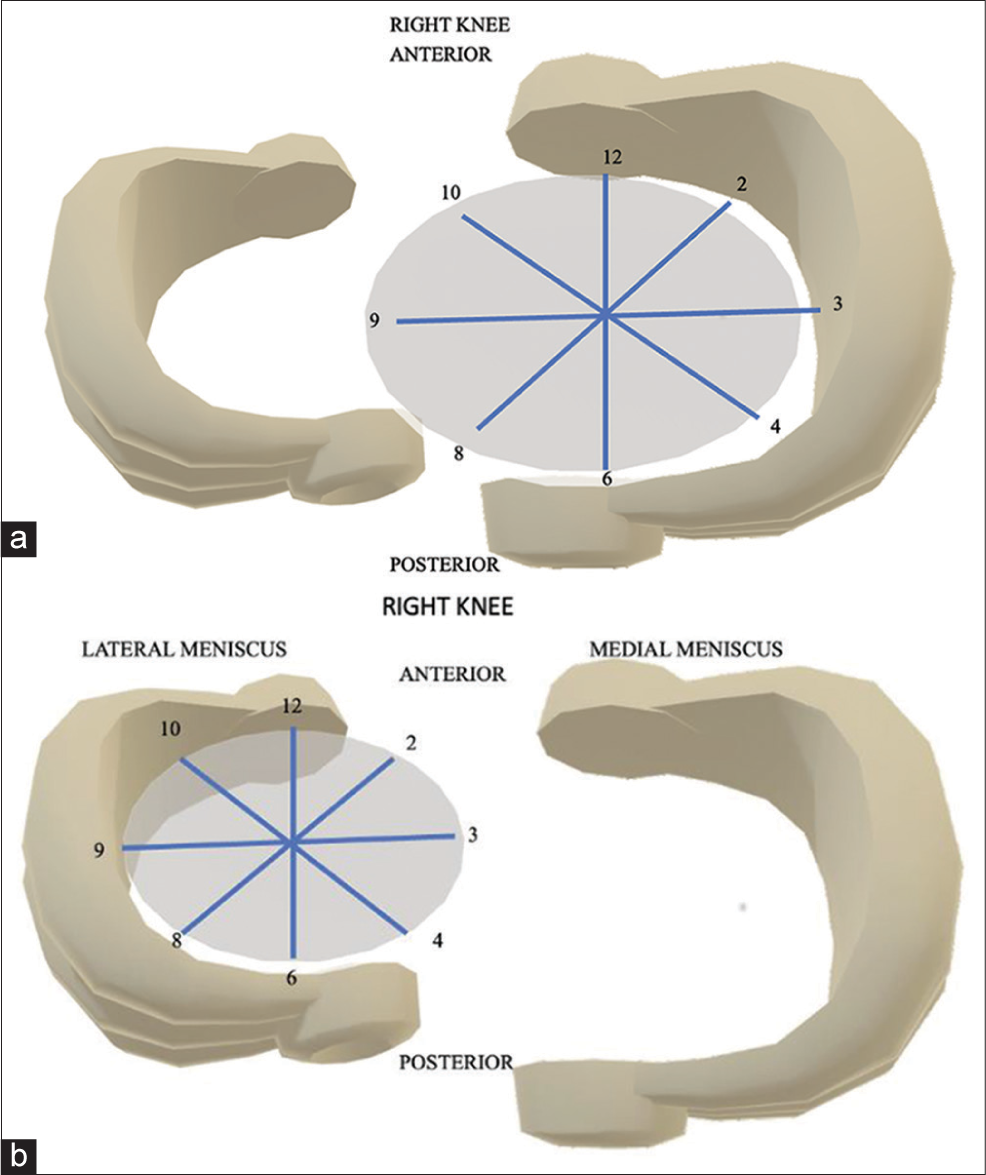 Displaced meniscal tears using clock face method: A pictorial essay