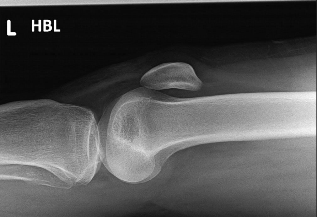 Traumatic prepatellar quadriceps continuation injury in an elite cyclist