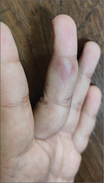 A resident’s sharp learning curve: Post-needle stick injury arteriovenous fistula of the finger