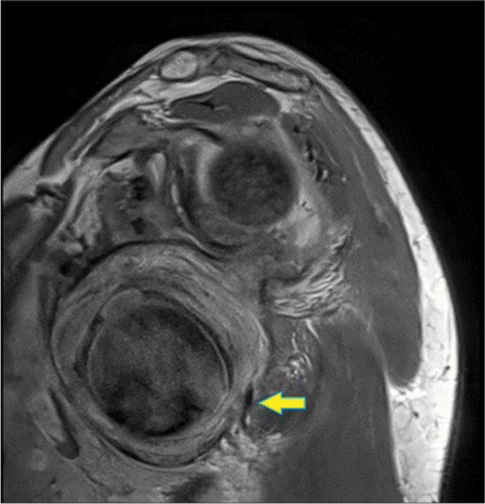 A rare case of acute traumatic complicated right axillary artery pseudoaneurysm with quadrangular space syndrome