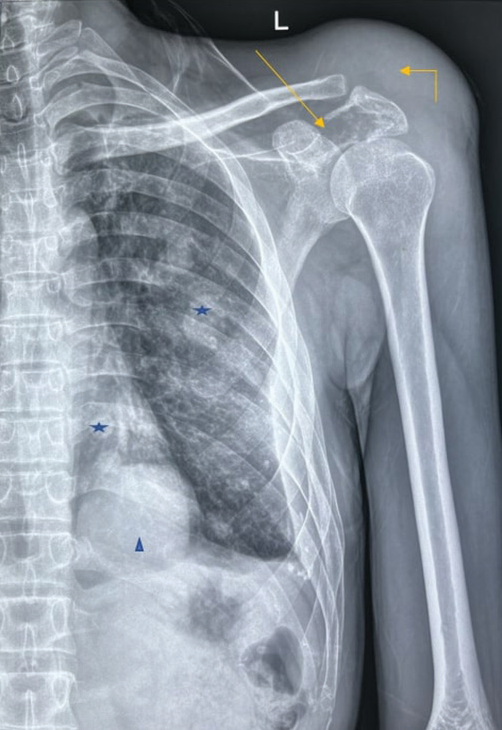 An atypical presentation of Ewing’s sarcoma of the scapula in an elderly male: A case report