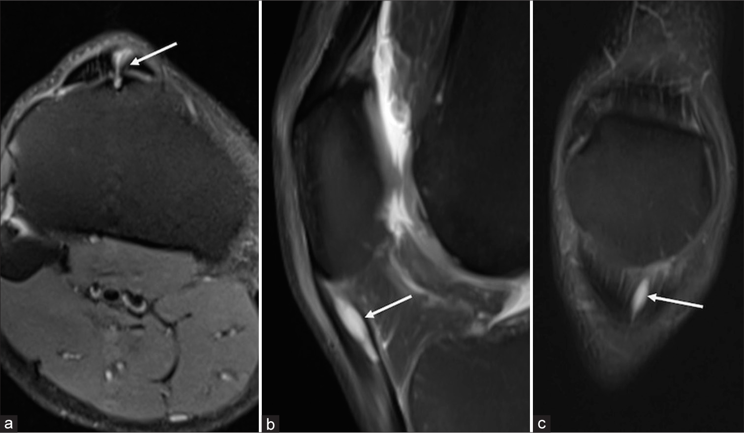 Unusual etiology of anterior knee pain in a young athlete engaged in chronic jumping exercises: The intratendinous ganglionic cyst of the patellar tendon