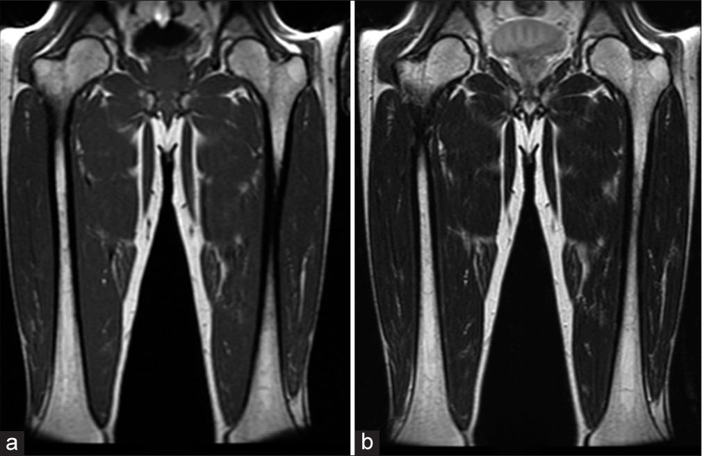 Gaucher disease: A review of MSK MRI protocol and peripheral skeletal MRI findings