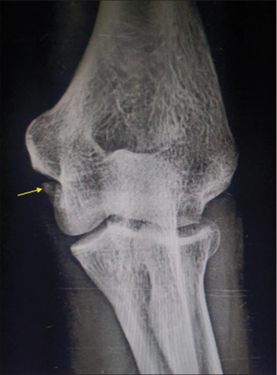 Imaging findings of thrower’s elbow in a fast bowler: A case report