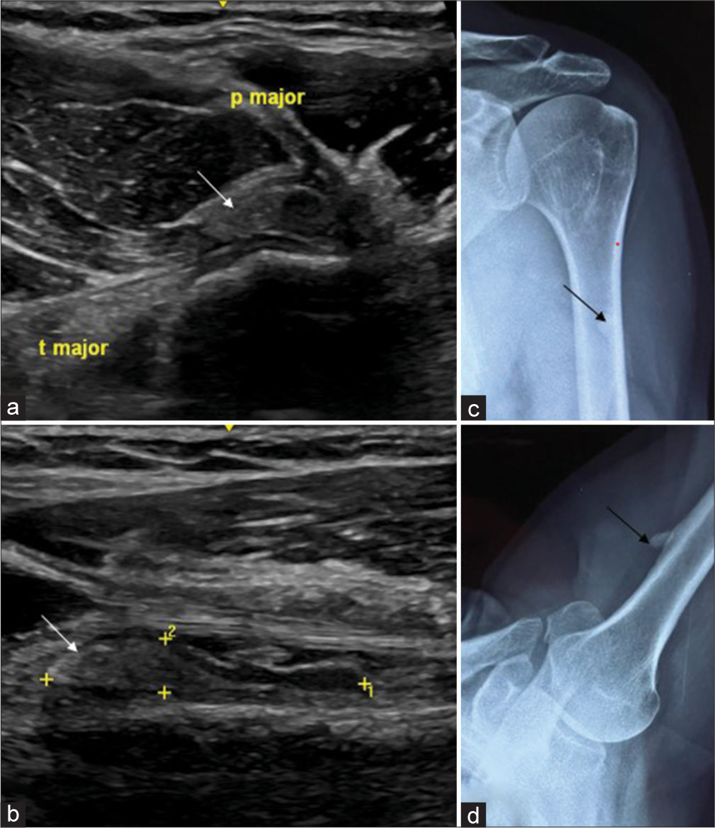 Ultrasound-guided aspiration and barbotage of acute calcific tendonitis in unusual locations