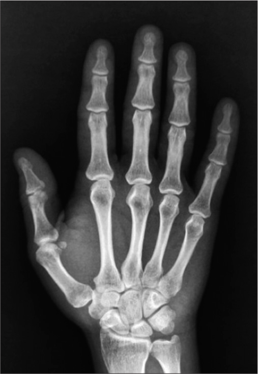 Extensor carpi ulnaris longitudinal tear: An overlooked etiology of ulnar-sided wrist pain