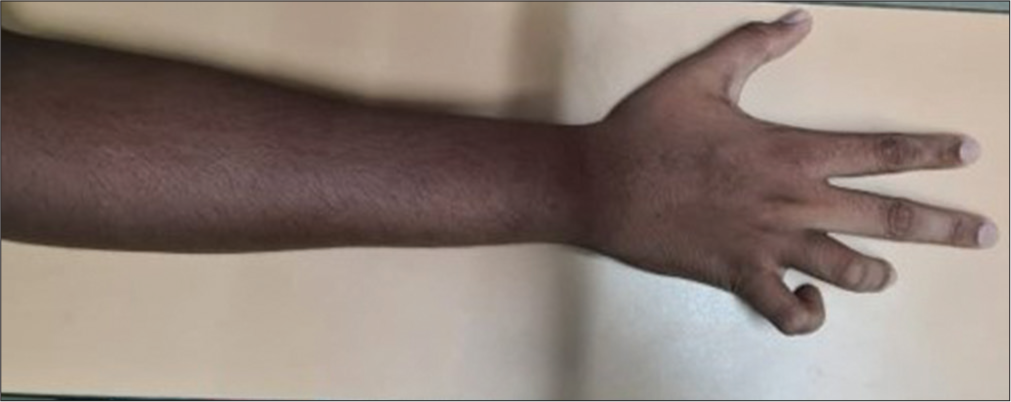 A rare presentation of cubital tunnel syndrome by accessory anconeus muscle