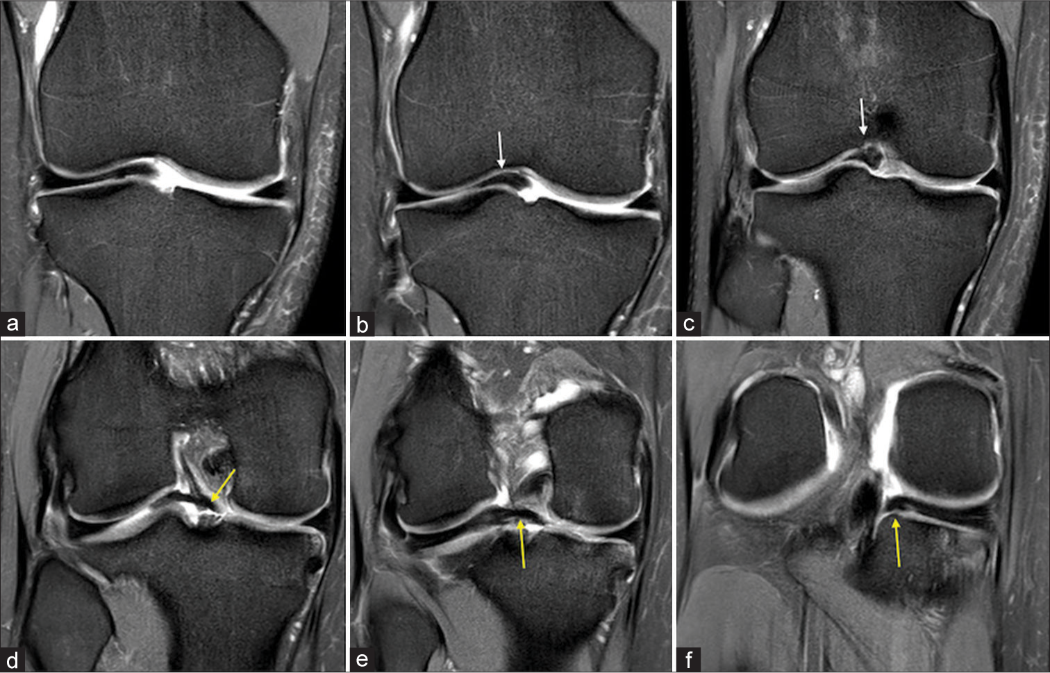 Ring-shaped meniscus with absent anterior cruciate ligament: A rare association with review of the literature