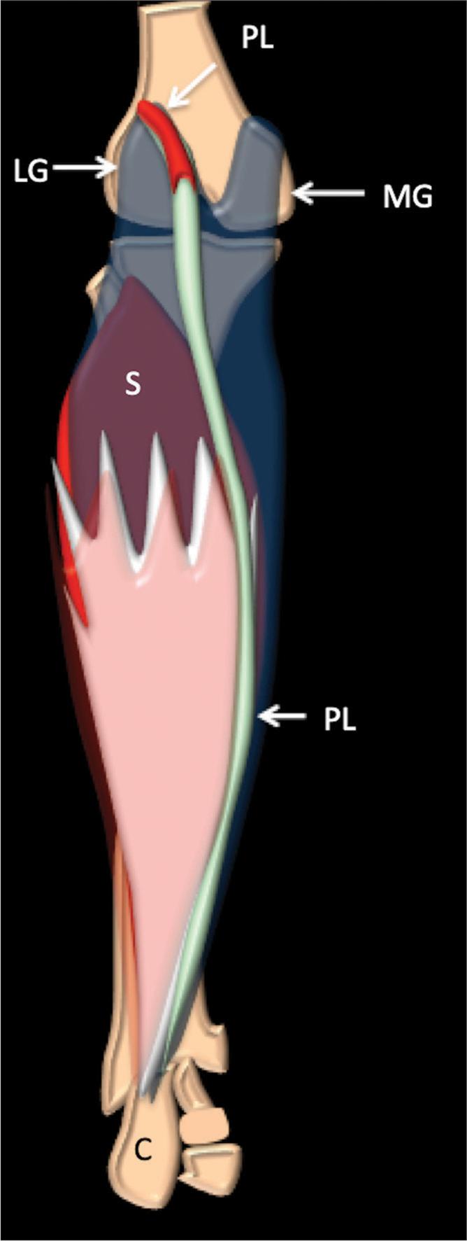 Isolated distal plantaris tendon rupture – An unusual cause of posterior calf pain