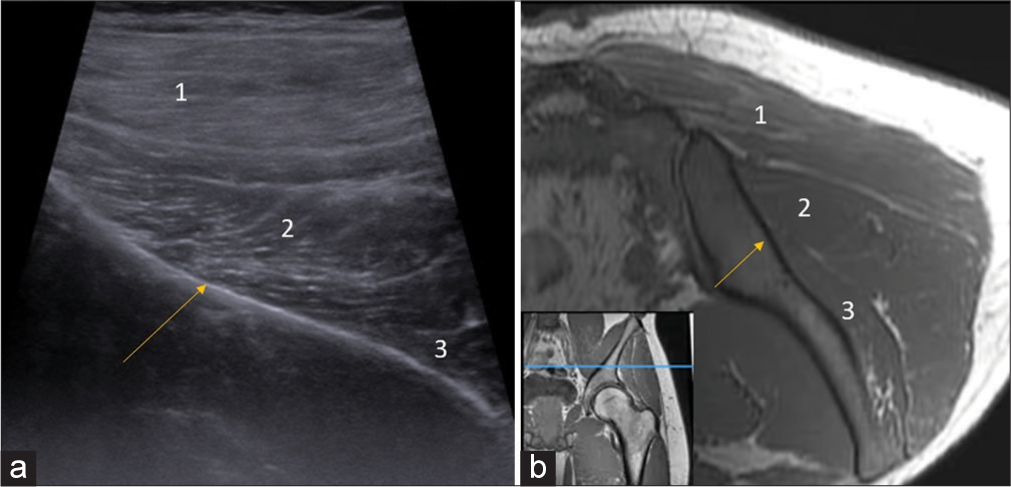 Demystifying Pandora’s box: A landmark-based approach for gluteal region ultrasound with magnetic resonance imaging correlation