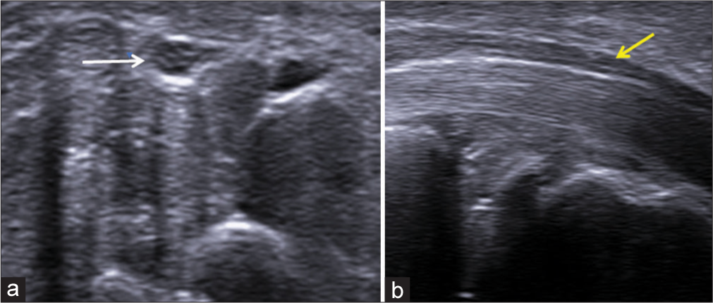 Revisiting ultrasound assessment of median nerve in carpal tunnel syndrome: A review