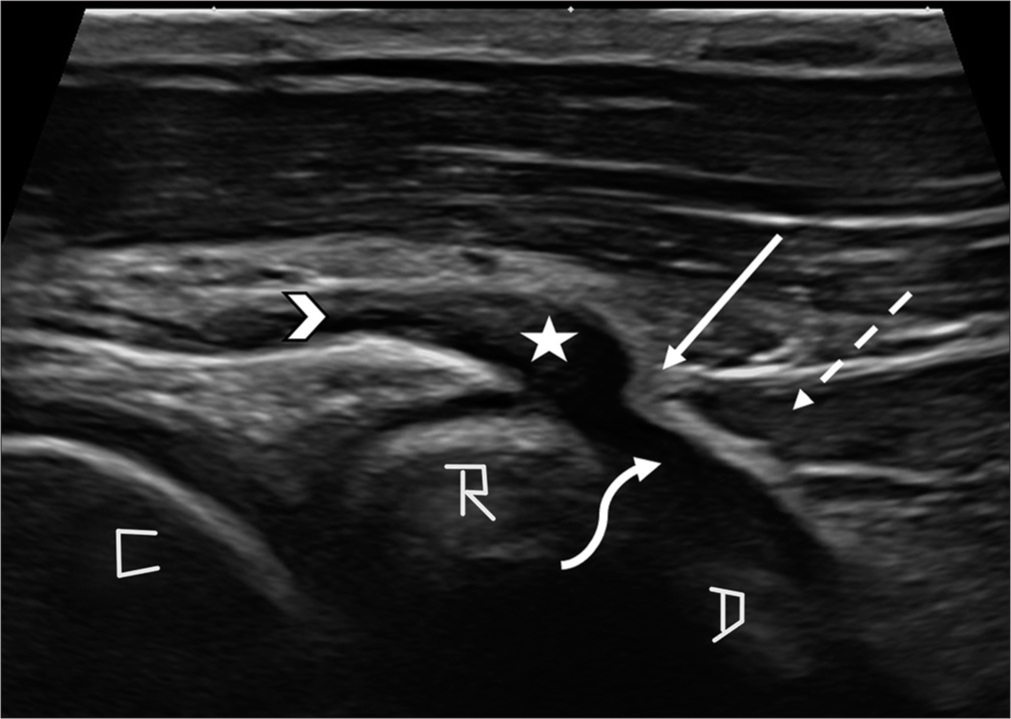 Ultrasound acting as a guiding light in the diagnosis of posterior interosseous nerve entrapment at ligament of Frohse – A case report