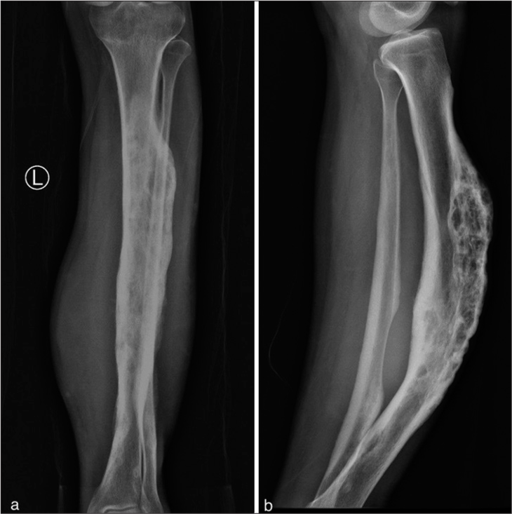 Soft-tissue tumor of myoepithelial origin in leg with secondary bone changes: A rare case report