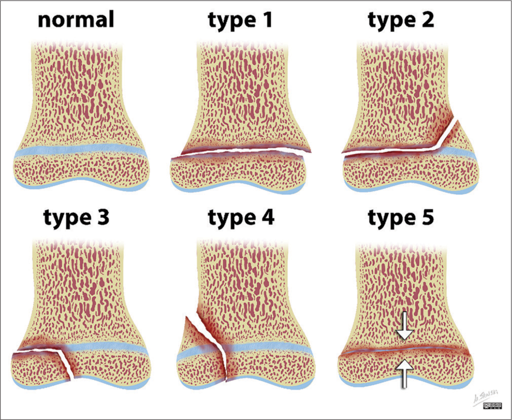 Distal femoral physeal fracture-dislocation (Salter-Harris-I) in a newborn: A case report