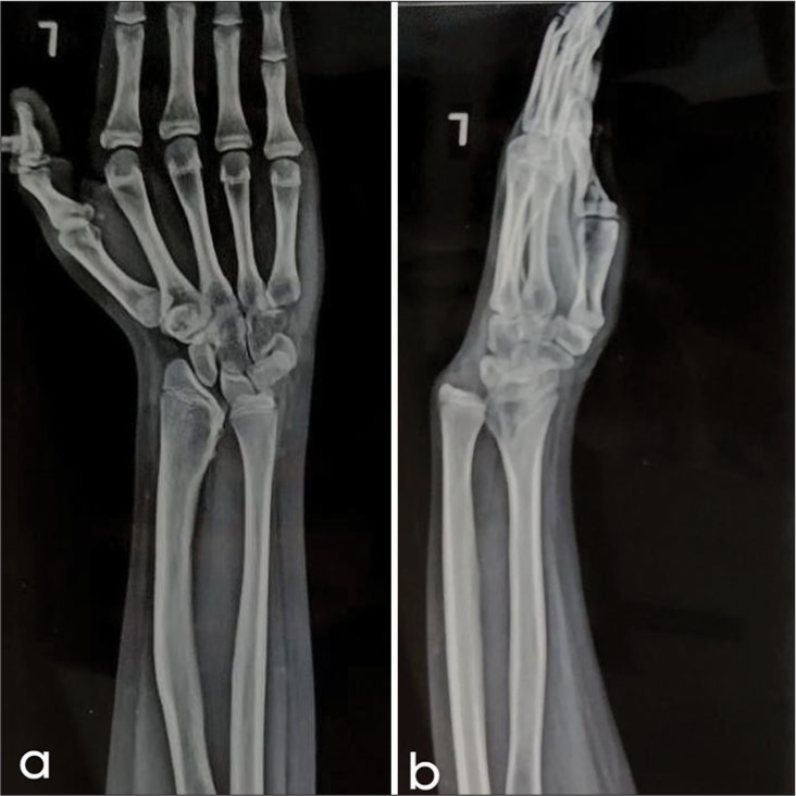 Atypical case of wrist pain in young with Madelung deformity