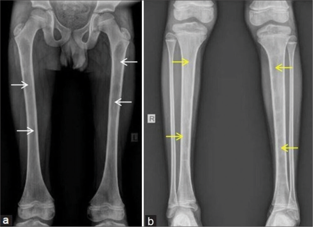 An unusual cause of intramedullary bone cysts – Congenital afibrinogenemia