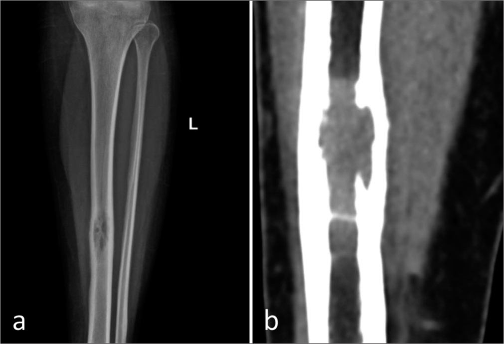 A rare presentation of isolated intraosseous Rosai-Dorfman disease of the tibia – The role of whole-body magnetic resonance imaging in management