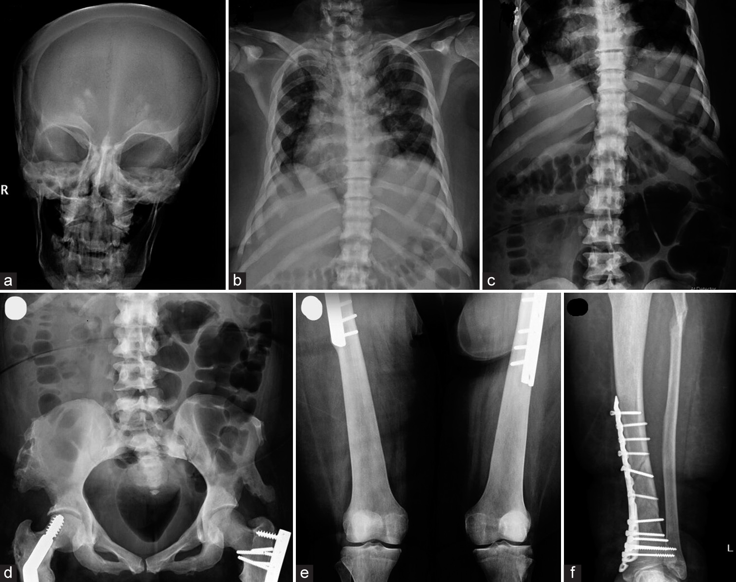 Renal tubular acidosis, osteopetrosis, and cerebral calcification – The triad of carbonic anhydrase II deficiency