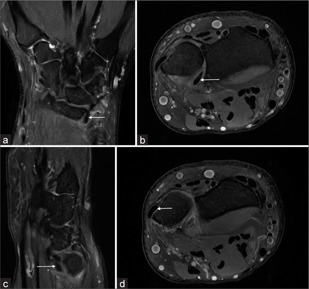 Displaced flap tear of the triangular fibrocartilage complex – A case report