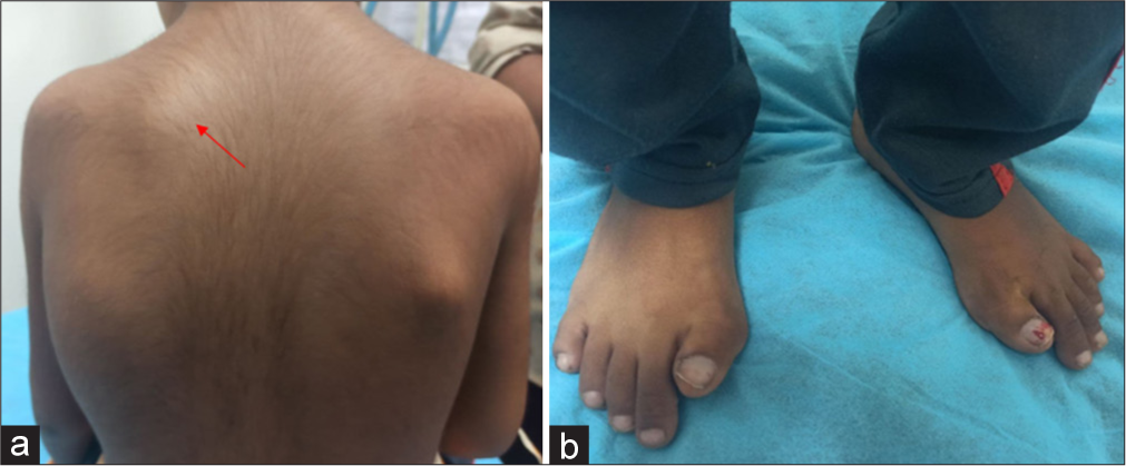 Imaging appearance of pre-osseous and osseous phase of fibrodysplasia ossificans progressiva: A rare entity