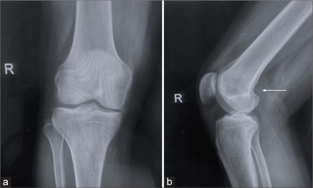 Periosteal desmoid tumor: A benign-appearing lesion manifesting as smooth metaphyseal scalloping of the femur on plain radiography